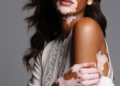 Modelo com Vitiligo Marina Duarte faz sucesso nas passarelas